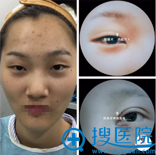 <!--<i data=20240710 data-id=12610></i>-->整形谢文文双眼皮术后即刻效果