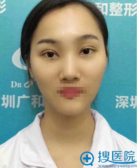 谢文文双眼皮拆线后效果