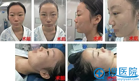 陈邦胤假体隆鼻+耳软骨垫鼻尖术前术后对比