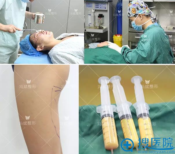 大腿吸脂和面部填充手术过程
