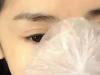 隆鼻手术后怎么护理伤口恢复快？ 北京八大处尹宏宇博士告诉你