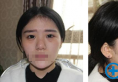 西安施尔绮苏鹏隆鼻案例：假体隆鼻+鼻头缩小术后半年效果展示