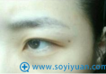 江苏南京省中医院整形外科刘育凤双眼皮修复案例术后半年恢复照