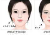 深圳美莱告诉你：瘦脸应该选还是瘦脸针？可以一起用吗？