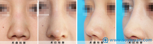 深圳广和隆鼻术后修复+肋软骨隆鼻尖案例