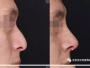 歪鼻矫正手术是怎样做的 北京沃尔刘彦军鼻中隔偏曲矫正全过程