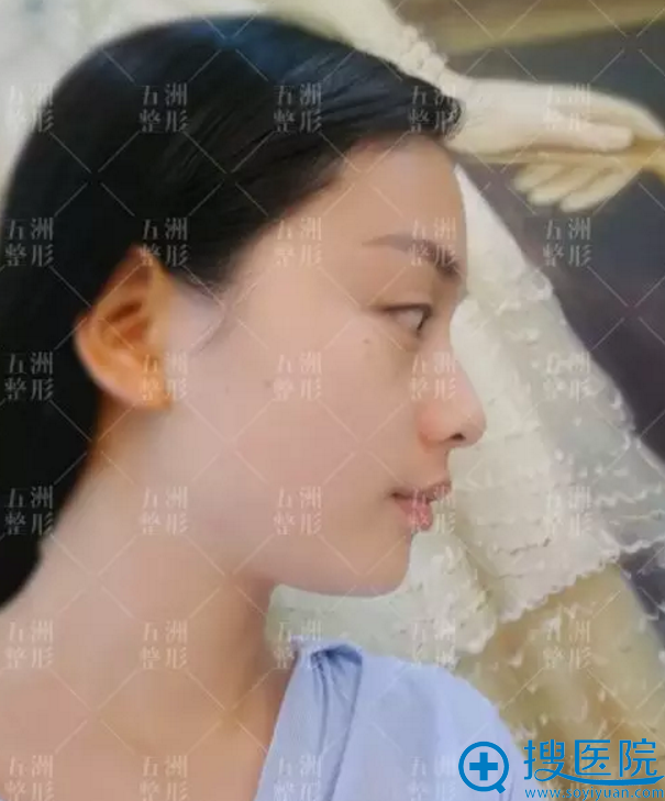 做鼻综合整形手术之前侧面照