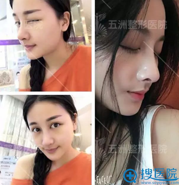 鼻综合整形手术7天恢复效果