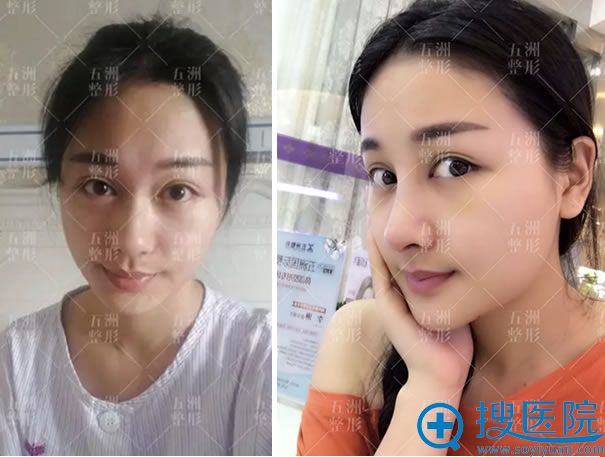 在五洲整形做隆鼻3个月效果对比图