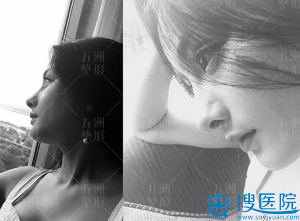 武汉五洲刘骏做鼻子效果怎么样