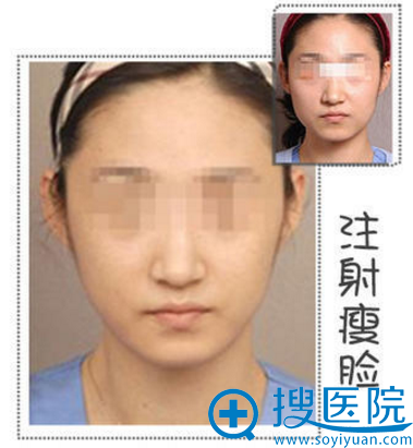 iFaceע䰸