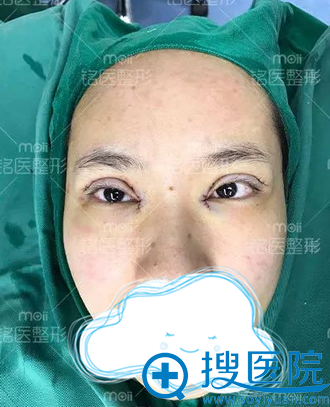 深圳铭医切开双眼皮+开眼角术后即刻