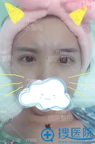 双眼皮+开眼角拆线后效果