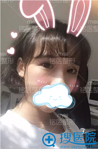 双眼皮术后化了淡妆的橙子