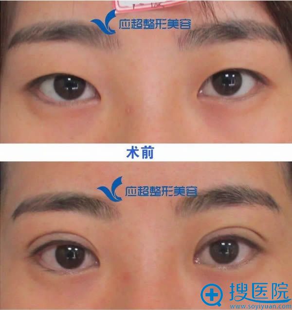 双眼皮术后一周对比效果 双眼皮术后一周对比效果