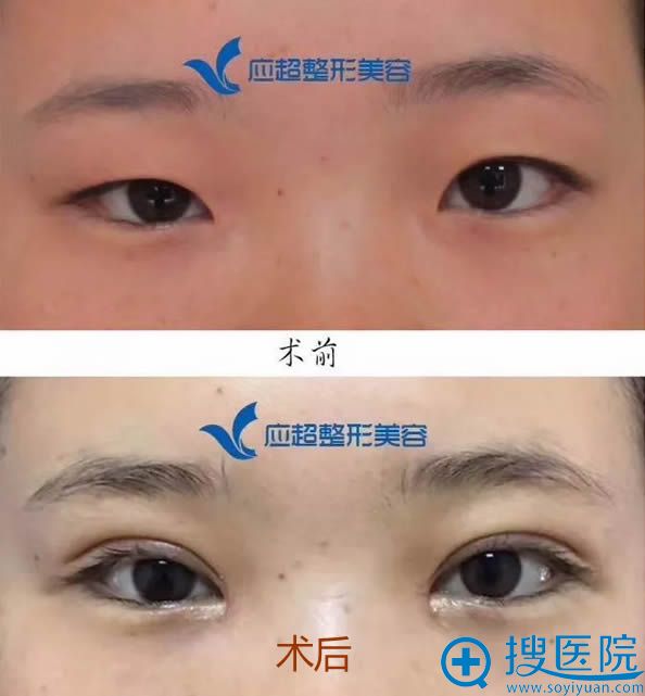 重睑内眦手术后20天前后对比照 重睑内眦手术后20天前后对比照