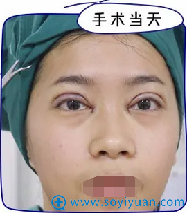 刚做完手术 眼睛大了不少 刚做完手术 眼睛大了不少