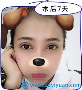 术后7天 已经拆线了 术后7天 已经拆线了