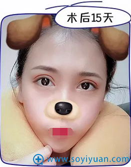 术后15天,萌妹纸一枚 术后15天,萌妹纸一枚