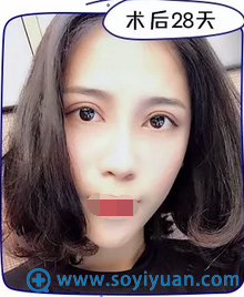 术后28天 很自然有木有 术后28天 很自然有木有