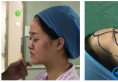 上个月我去上海华美找谢卫国院长做了鼻综合隆鼻和全脸脂肪填充