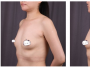 庆幸我选择上海华美整形医院谢卫国院长做了娜绮丽假体隆胸手术