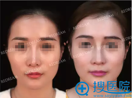 苏州薇琳歪鼻修复案例 假体置换 鼻中隔综合隆鼻让她重现光彩 歪鼻矫正 搜医院 苏州薇琳歪鼻修复案例 假体置换 鼻中隔综合隆鼻让她重现光彩 歪鼻矫正 搜医院