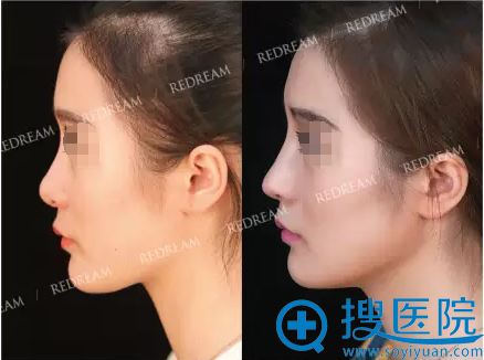 假体+鼻中隔软骨鼻综合修复术后侧面照