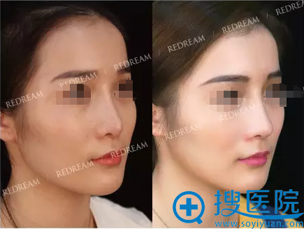 <!--<i data=20240710 data-id=11923></i>-->歪鼻修复术后45都对比照片