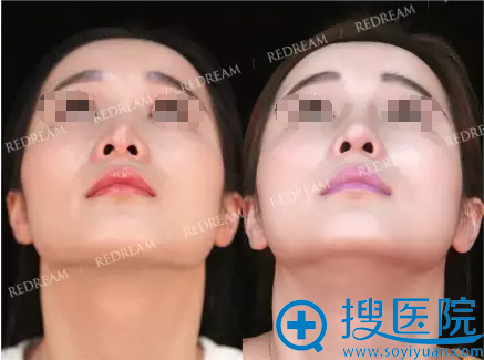 假体置换+自体软骨隆鼻术后鼻底对比