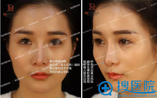 术前假体痕迹明显且明显的鼻尖歪斜