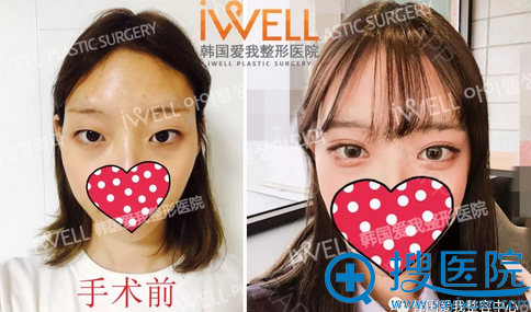韩国iwell整形双眼皮术后效果对比照