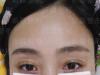 给大家透露一下我在新疆整形美容医院眼袋内切一月后效果图片