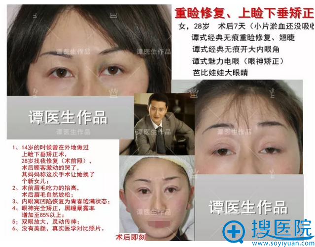 重睑修复、上睑下垂矫正