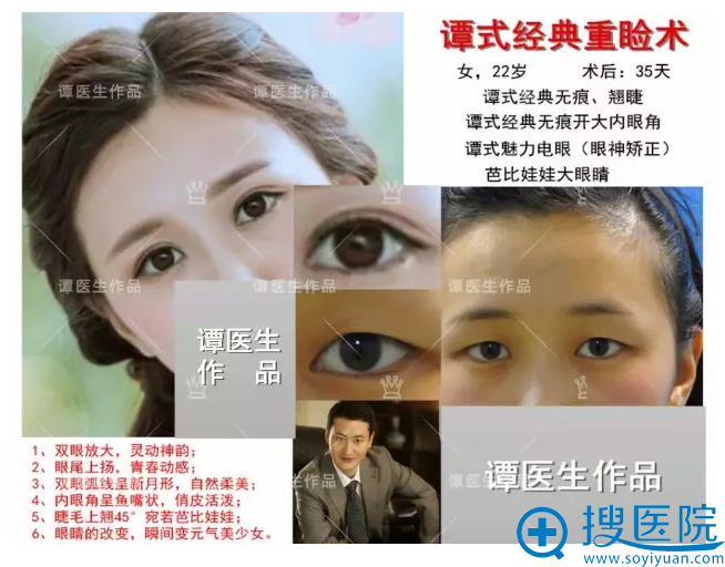 开大内眼角+无痕双眼皮