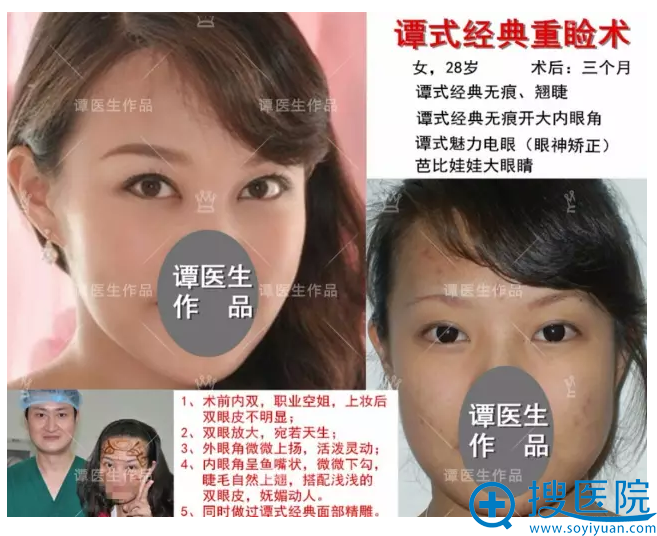 谭式经典重睑术