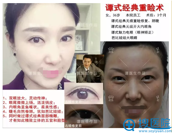 双眼皮+开眼角+面部精雕