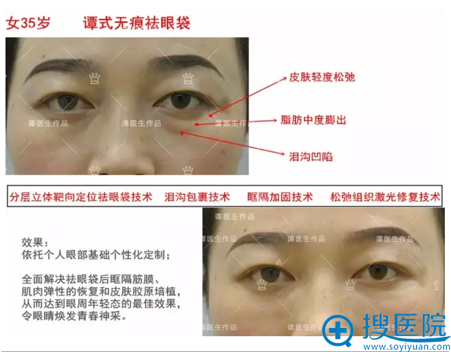 脂肪轻度膨出 术前术后