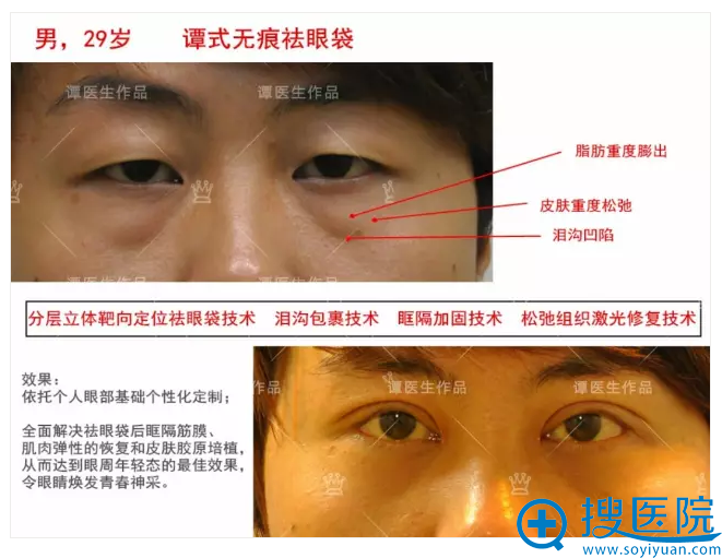 脂肪重度膨出 祛眼袋+双眼皮