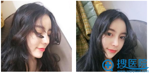 找杭州格莱美张龙做完隆鼻1个月了 找杭州格莱美张龙做完隆鼻1个月了
