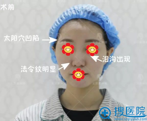 在莫琳娜做自体脂肪填充前照片