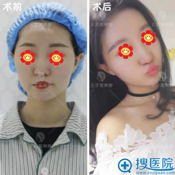 <!--<i data=20240710 data-id=12446></i>-->脂肪填充案例前后效果对比图