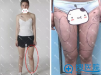 重庆华美张梅大腿吸脂抽出2000ml脂肪 大腿腿围从56变51