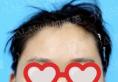 北京加减美整形黄寅守2个月前帮我做了V美瘦脸波纹式颧骨缩小术
