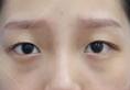 杭州格莱美公布2018一季度成交量top3的眼部整形项目及真人案例