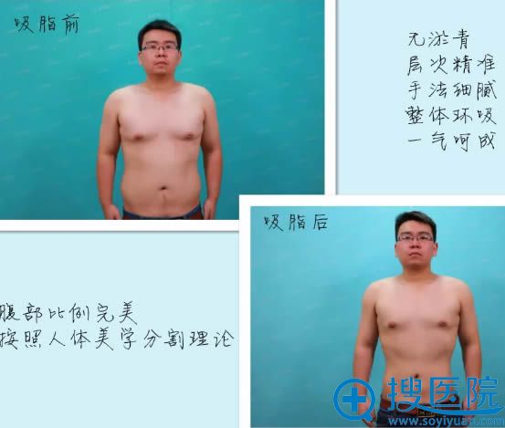 重庆星宸石冰为我做完胸部和腰腹部水动力吸脂三个月对比照
