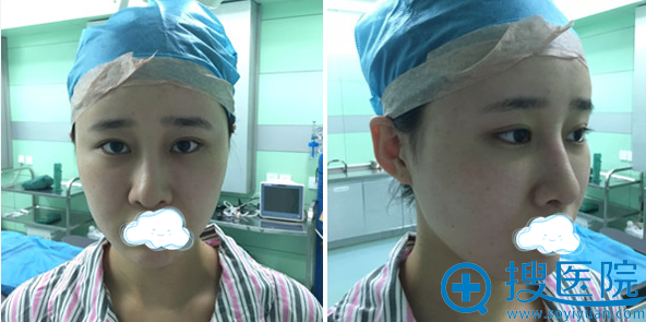 3次隆鼻手术失败后照片 3次隆鼻手术失败后照片