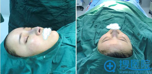 王文戈鼻修复手术术后即刻效果 王文戈鼻修复手术术后即刻效果