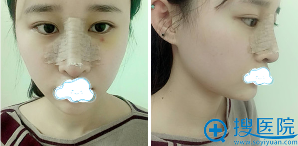 王文革耳软骨鼻综合术后5天恢复情况 王文革耳软骨鼻综合术后5天恢复情况