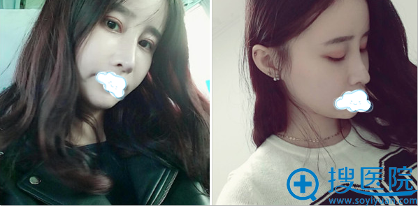 假体+耳软骨鼻综合术后18天效果 假体+耳软骨鼻综合术后18天效果